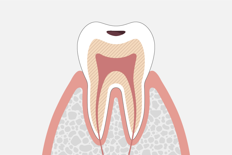 エナメル質の虫歯