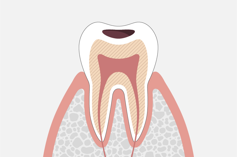 象牙質の虫歯