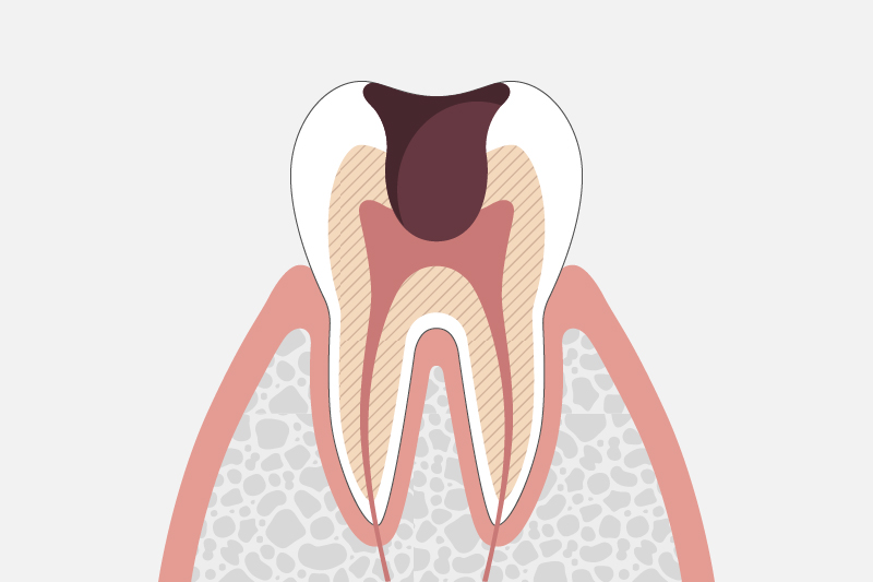 神経まで達した虫歯