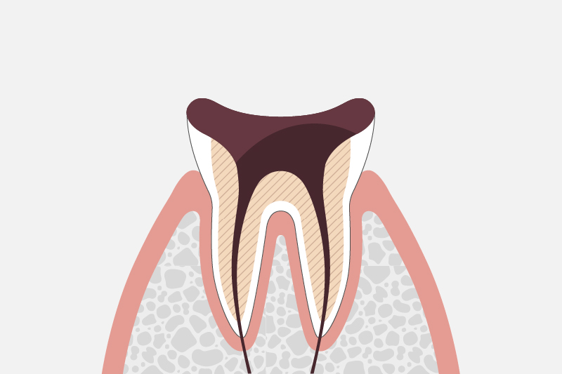 歯根まで達した虫歯